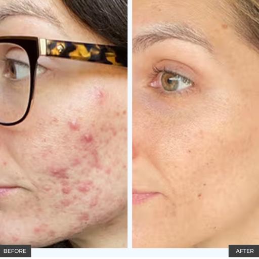 Organic Acne Facial
