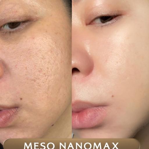 MesoNanomax