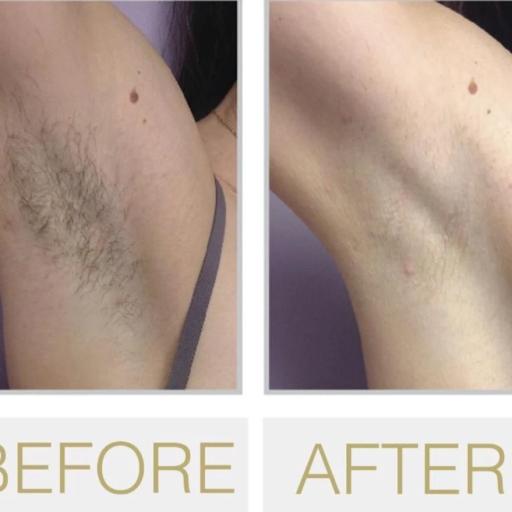 Mediostar Diode Underarm Hair Removal