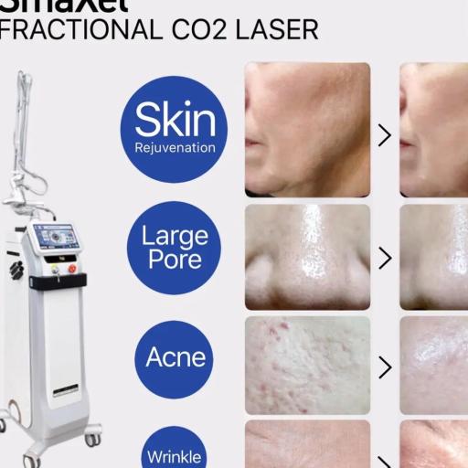 Smart C02 Fractional Laser (Smaxel)