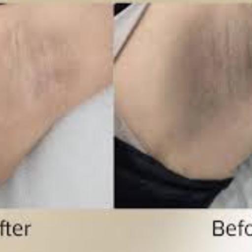 Underarm Diamond Peel with Mask